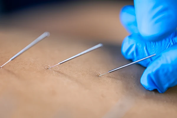 Dry Needling Physiotherapy Near Me in Melbourne