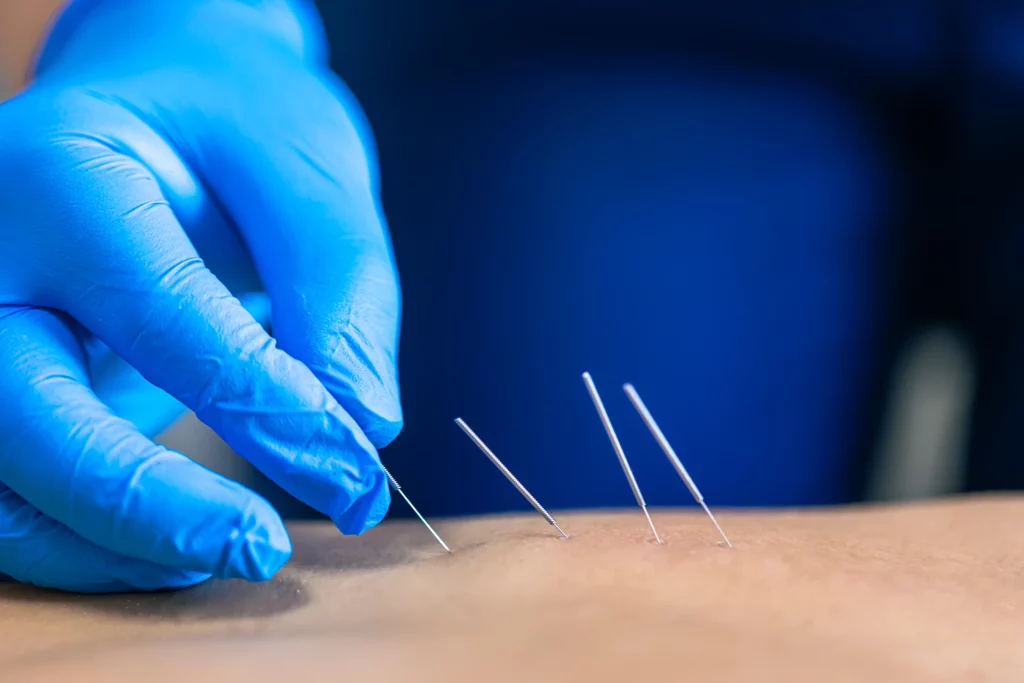 Physiotherapist performing dry needling for muscle trigger point release. Pain relief and rehab at Move More Physio Mulgrave Berwick.